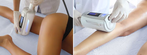 Endospheres Therapy results maintenance